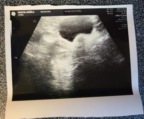 Martin IVF Journey